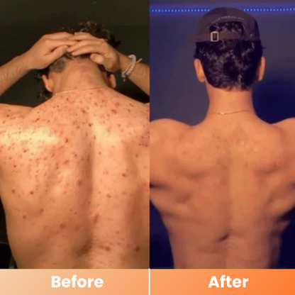 Dr.Melaxin® Peel Shot | Exfoliating Kojic Acid Turmeric Spray 200ml