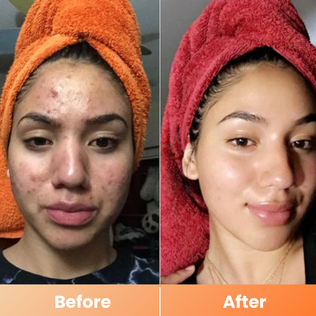 Dr.Melaxin® Peel Shot | Exfoliating Kojic Acid Turmeric Spray 200ml