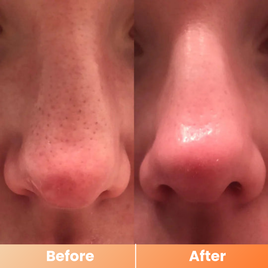 Dr.Melaxin® Peel Shot | Exfoliating Kojic Acid Turmeric Spray 200ml