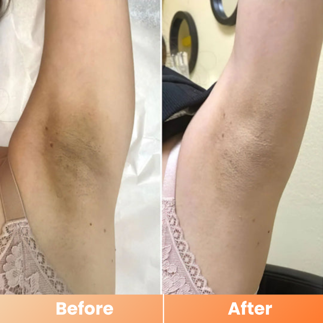 Dr.Melaxin® Peel Shot | Exfoliating Kojic Acid Turmeric Spray 200ml